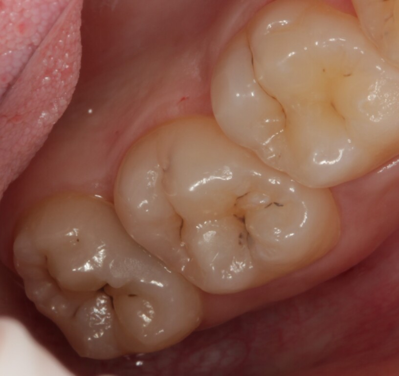 Лечение кариеса с реставрацией — до лечения