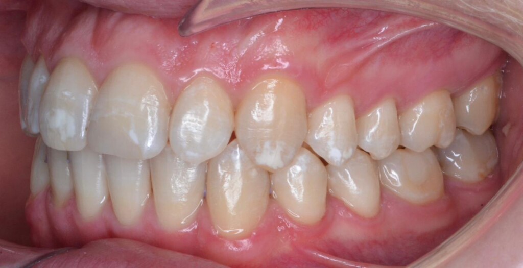 Лечение на элайнерах 3D Smile — после лечения